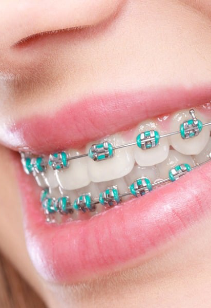braces-side-img