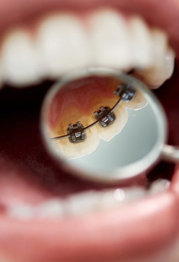 lingual-braces-side-img