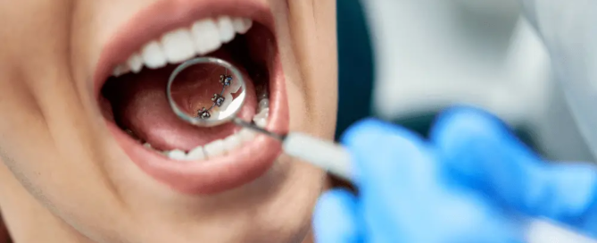 the-invisible-smile-exploring-lingual-braces-img