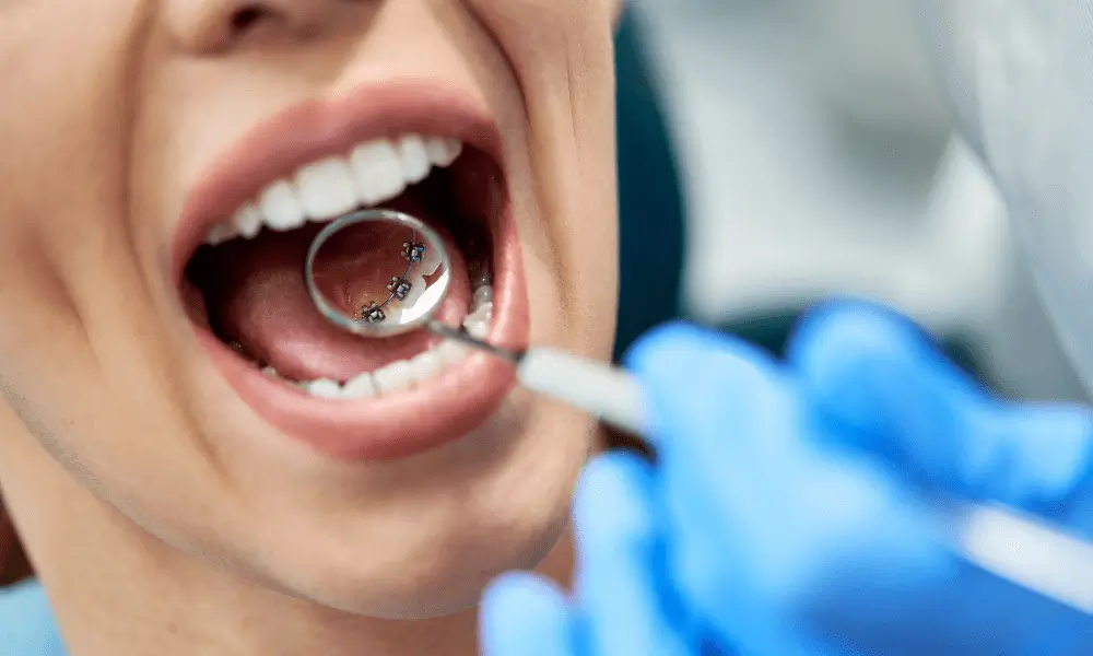 the-invisible-smile-exploring-lingual-braces-img